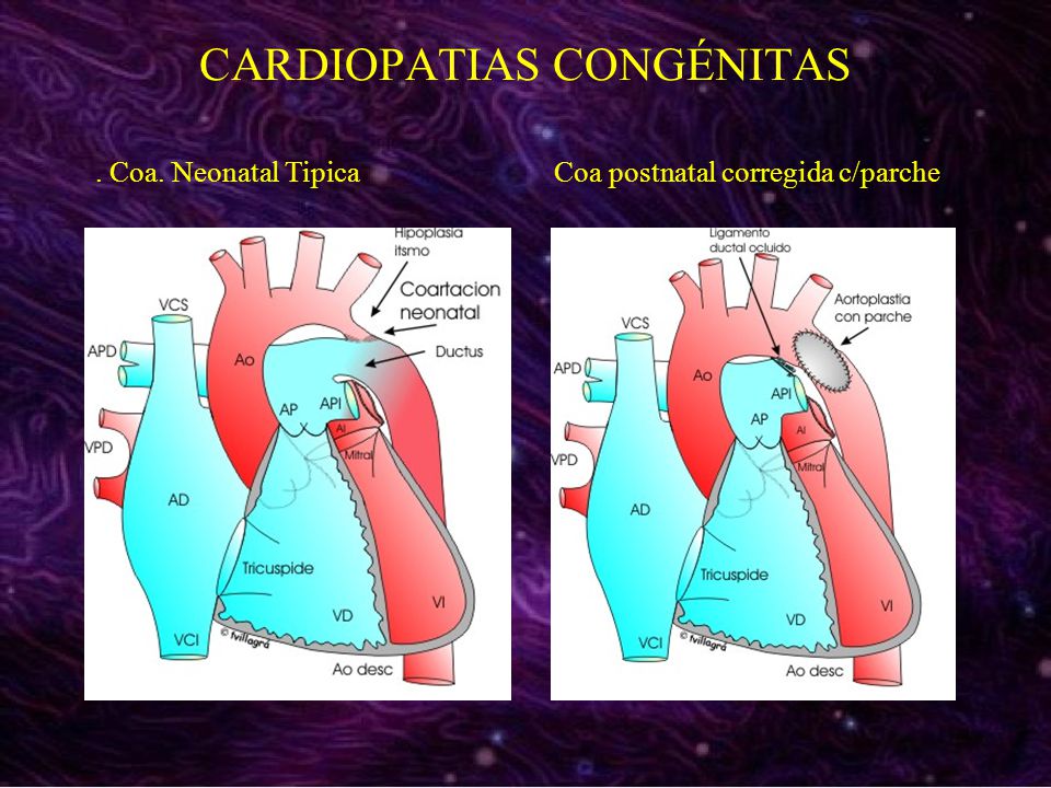 CARDIOPATIAS CONGÉNITAS