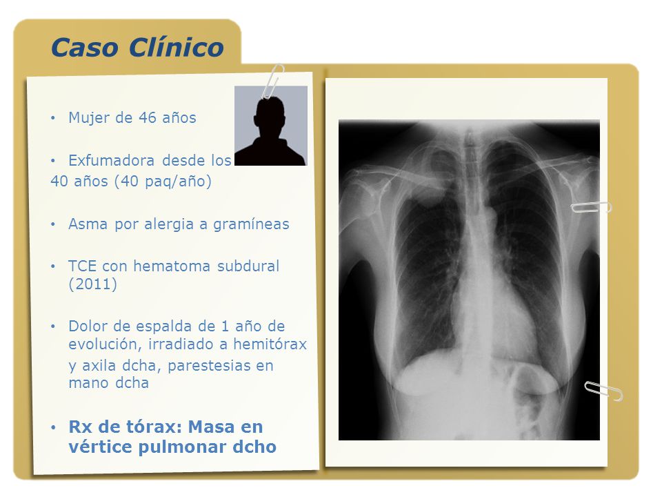 Caso Clínico Rx de tórax: Masa en vértice pulmonar dcho
