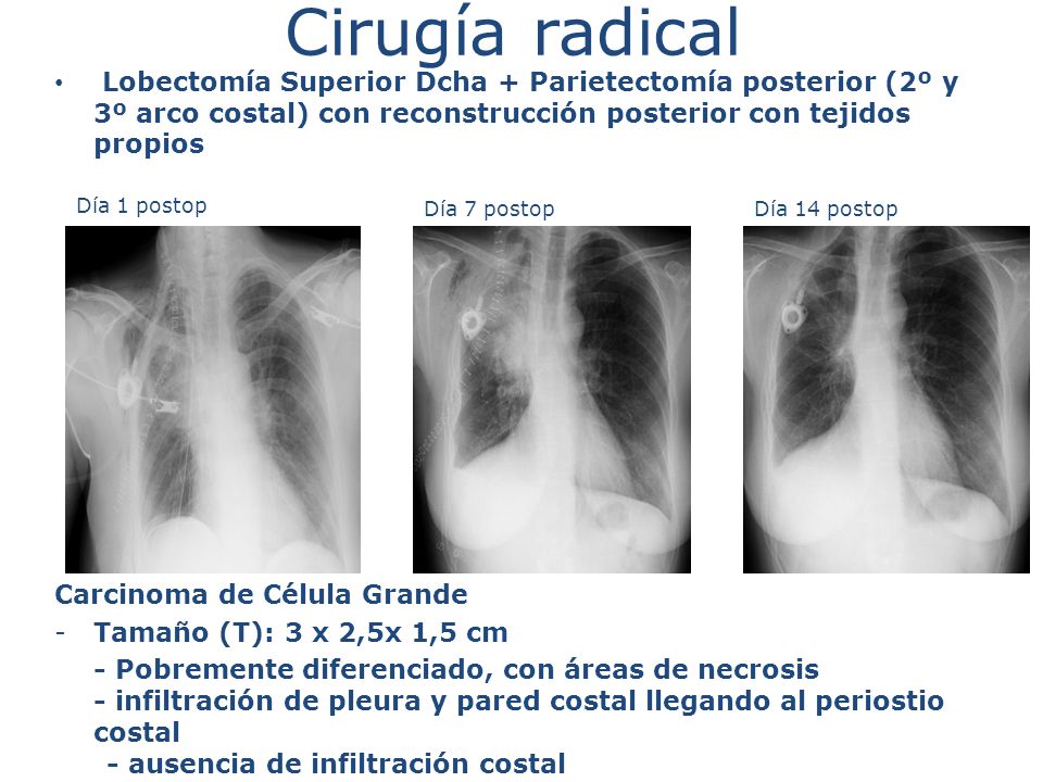 Cirugía radical Lobectomía Superior Dcha + Parietectomía posterior (2º y 3º arco costal) con reconstrucción posterior con tejidos propios.