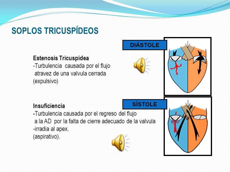 SOPLOS TRICUSPÍDEOS DIÁSTOLE. Estenosis Tricuspidea -Turbulencia causada por el flujo. atravez de una valvula cerrada.