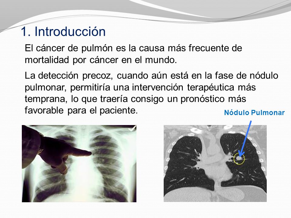 1. Introducción El cáncer de pulmón es la causa más frecuente de mortalidad por cáncer en el mundo.