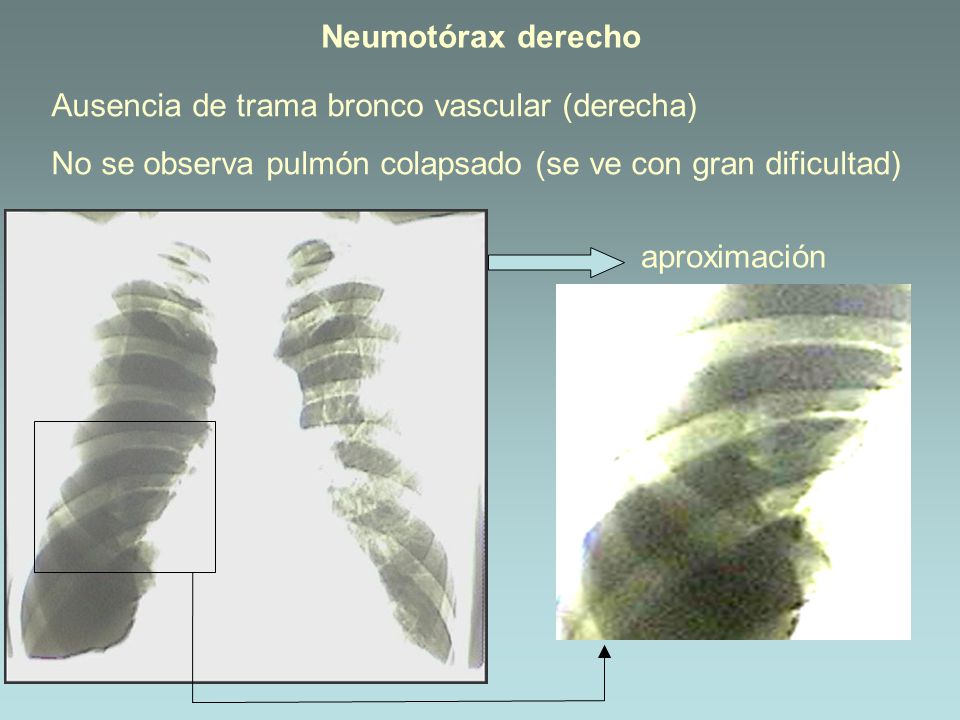 Neumotórax derecho Ausencia de trama bronco vascular (derecha) No se observa pulmón colapsado (se ve con gran dificultad)