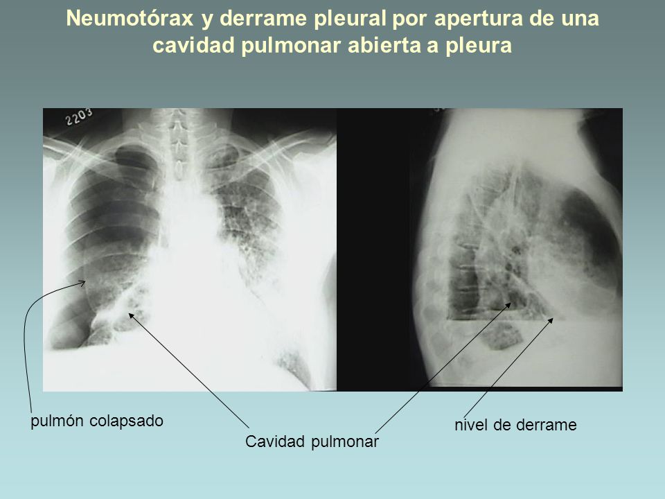 Neumotórax y derrame pleural por apertura de una cavidad pulmonar abierta a pleura