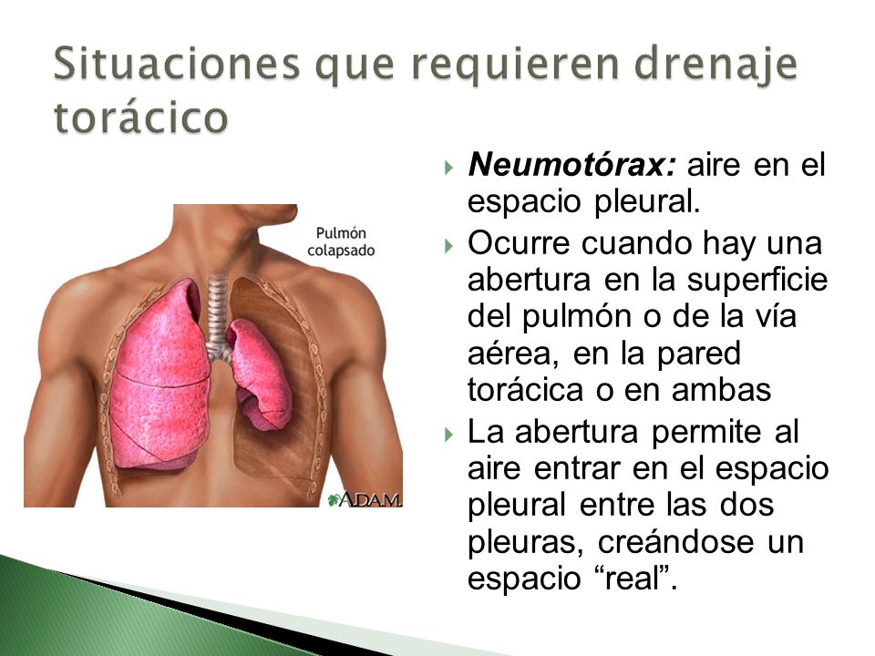 Situaciones que requieren drenaje torácico