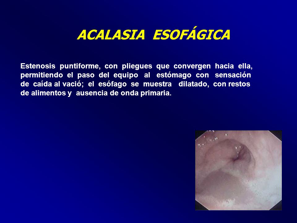 ACALASIA ESOFÁGICA Estenosis puntiforme, con pliegues que convergen hacia ella,