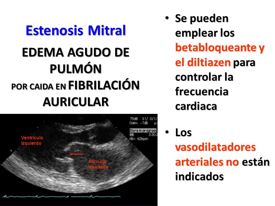 Se pueden emplear los betabloqueante y el diltiazen para controlar la frecuencia cardiaca