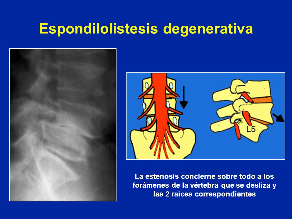 Espondilolistesis degenerativa