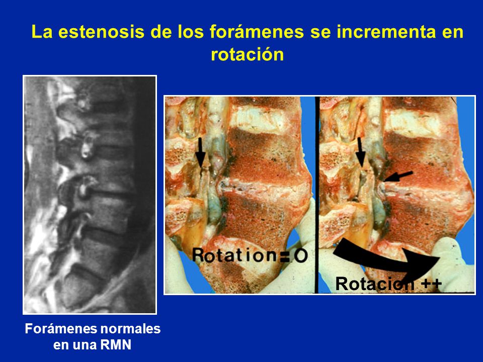 La estenosis de los forámenes se incrementa en rotación
