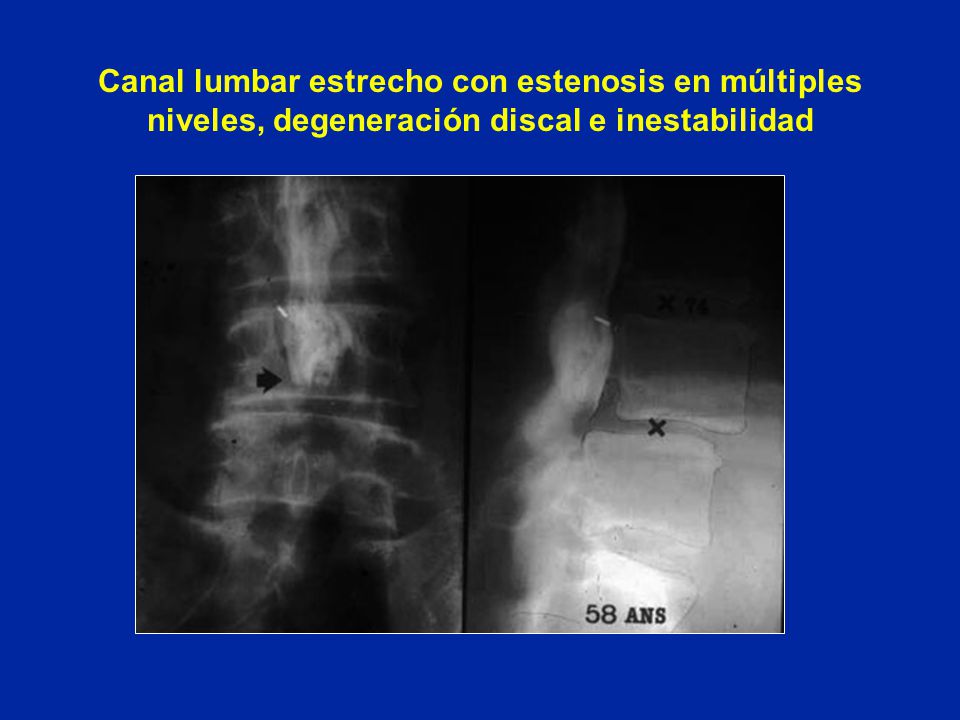 Canal lumbar estrecho con estenosis en múltiples niveles, degeneración discal e inestabilidad