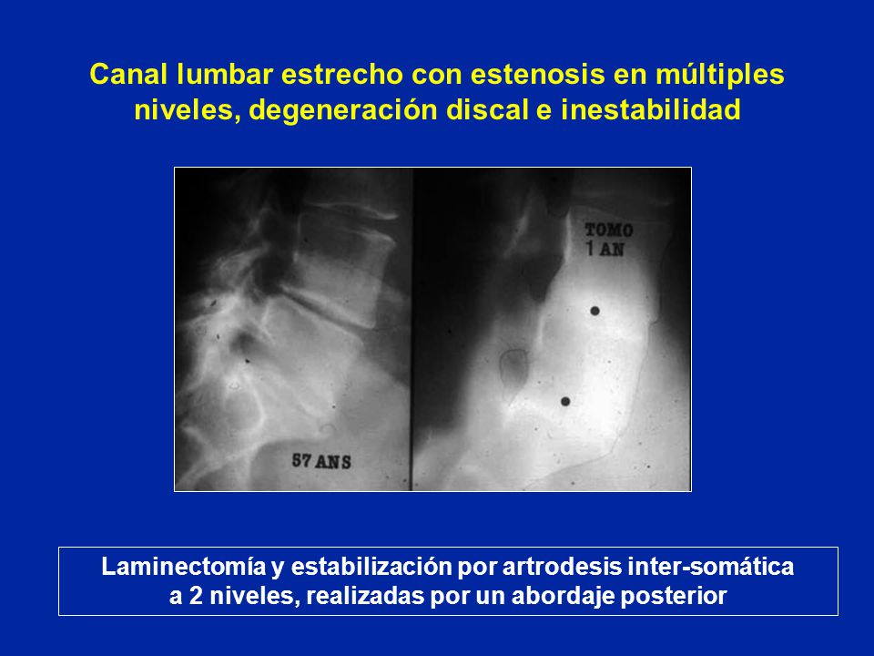 Canal lumbar estrecho con estenosis en múltiples niveles, degeneración discal e inestabilidad