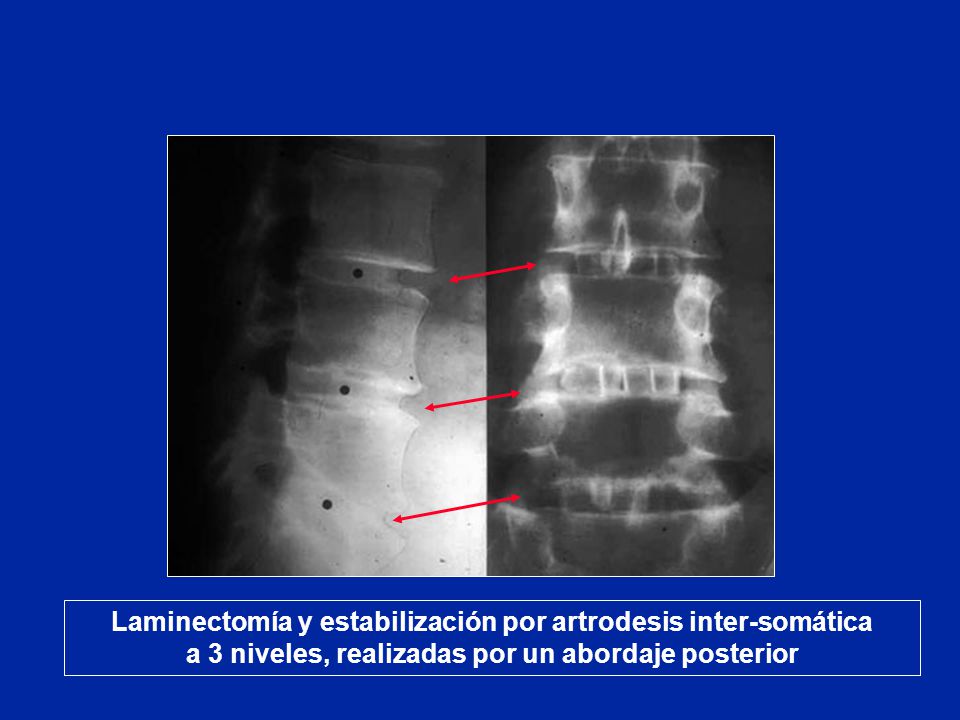 Laminectomía y estabilización por artrodesis inter-somática a 3 niveles, realizadas por un abordaje posterior