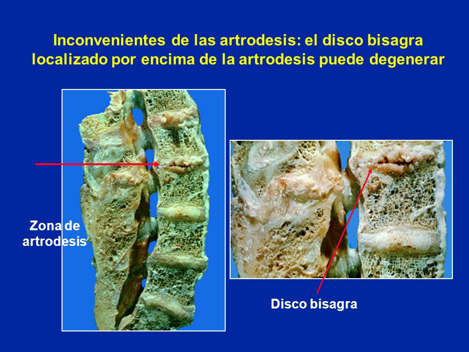 Inconvenientes de las artrodesis: el disco bisagra localizado por encima de la artrodesis puede degenerar