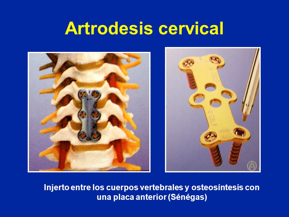 Artrodesis cervical Injerto entre los cuerpos vertebrales y osteosíntesis con una placa anterior (Sénégas)