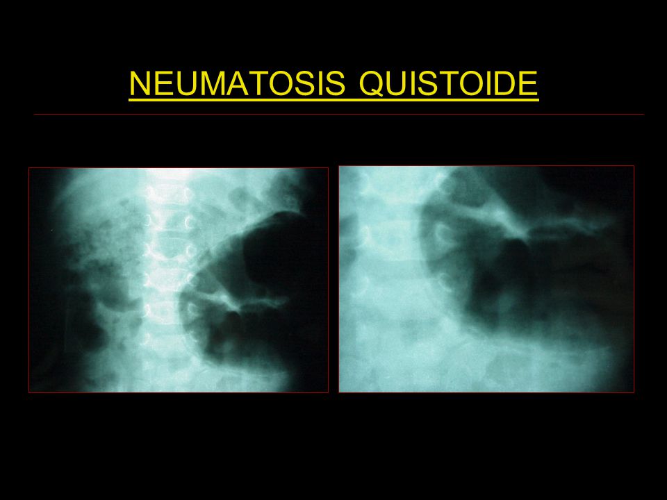 NEUMATOSIS QUISTOIDE