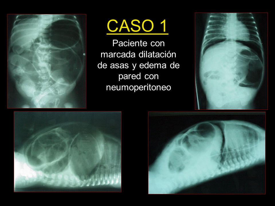 CASO 1 Paciente con marcada dilatación de asas y edema de pared con neumoperitoneo