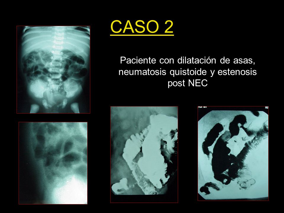 CASO 2 Paciente con dilatación de asas, neumatosis quistoide y estenosis post NEC