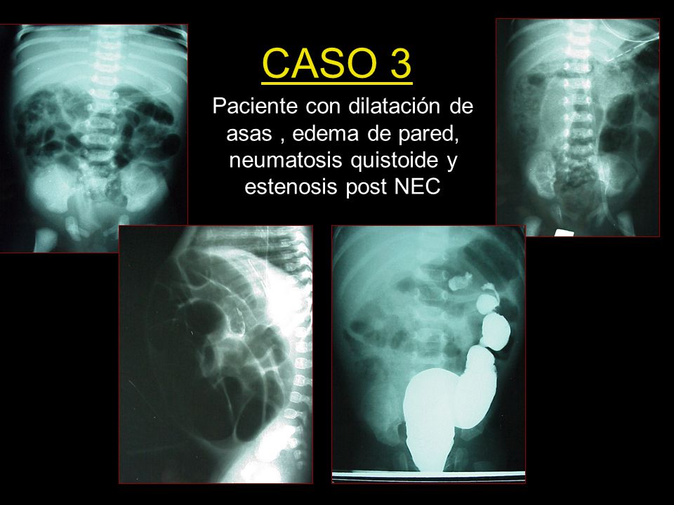 CASO 3 Paciente con dilatación de asas , edema de pared, neumatosis quistoide y estenosis post NEC