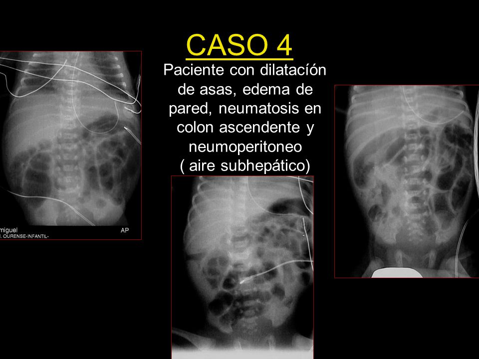 CASO 4 Paciente con dilatacíón de asas, edema de pared, neumatosis en colon ascendente y neumoperitoneo ( aire subhepático)