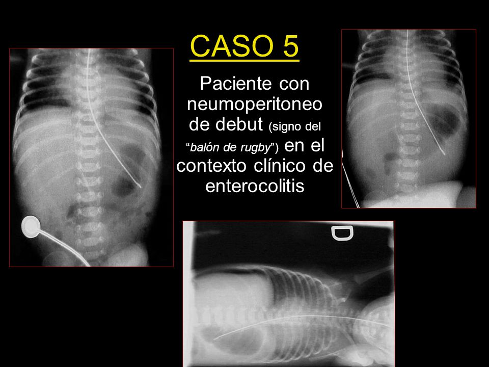 CASO 5 Paciente con neumoperitoneo de debut (signo del balón de rugby ) en el contexto clínico de enterocolitis.