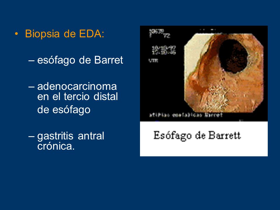 Biopsia de EDA: esófago de Barret. adenocarcinoma en el tercio distal.