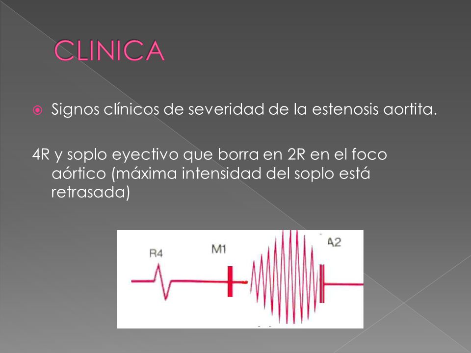 CLINICA Signos clínicos de severidad de la estenosis aortita.