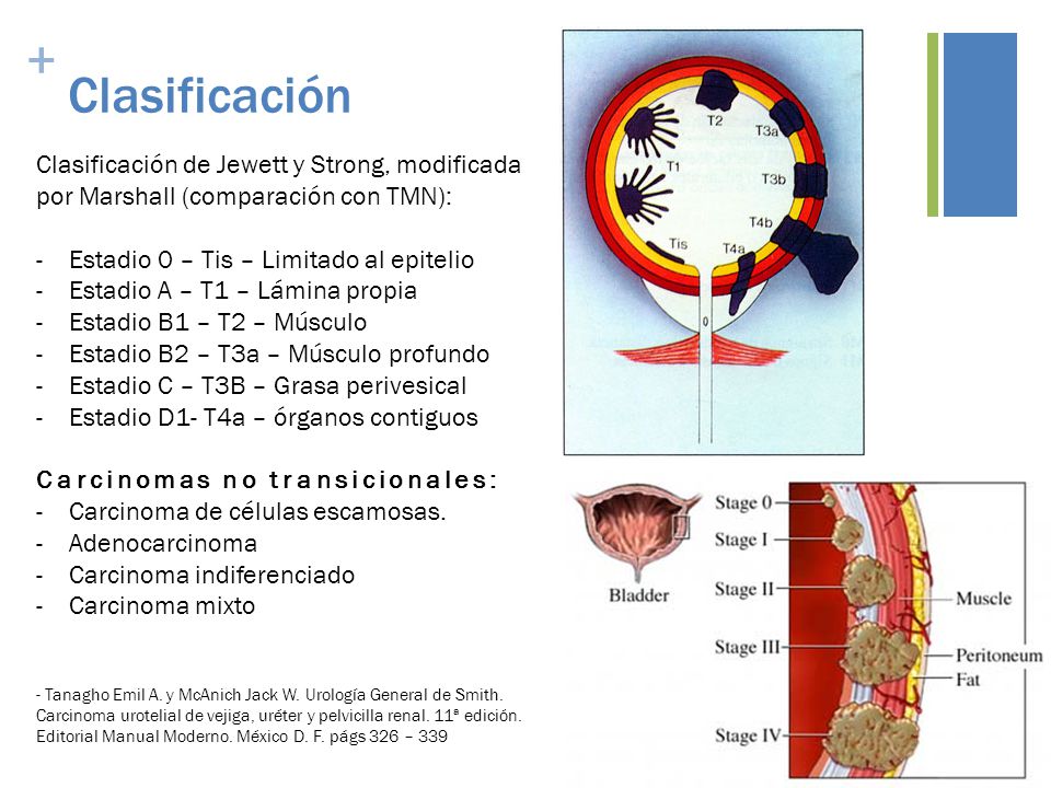 Clasificación Clasificación de Jewett y Strong, modificada por Marshall (comparación con TMN): Estadio 0 – Tis – Limitado al epitelio.