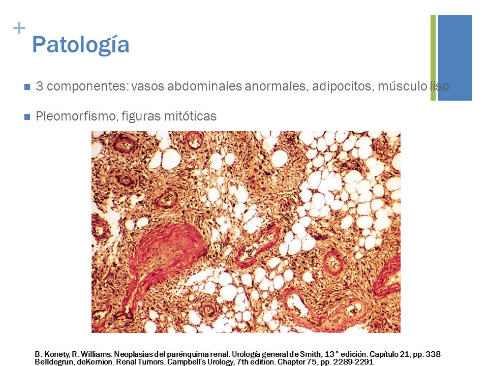 Patología 3 componentes: vasos abdominales anormales, adipocitos, músculo liso. Pleomorfismo, figuras mitóticas.
