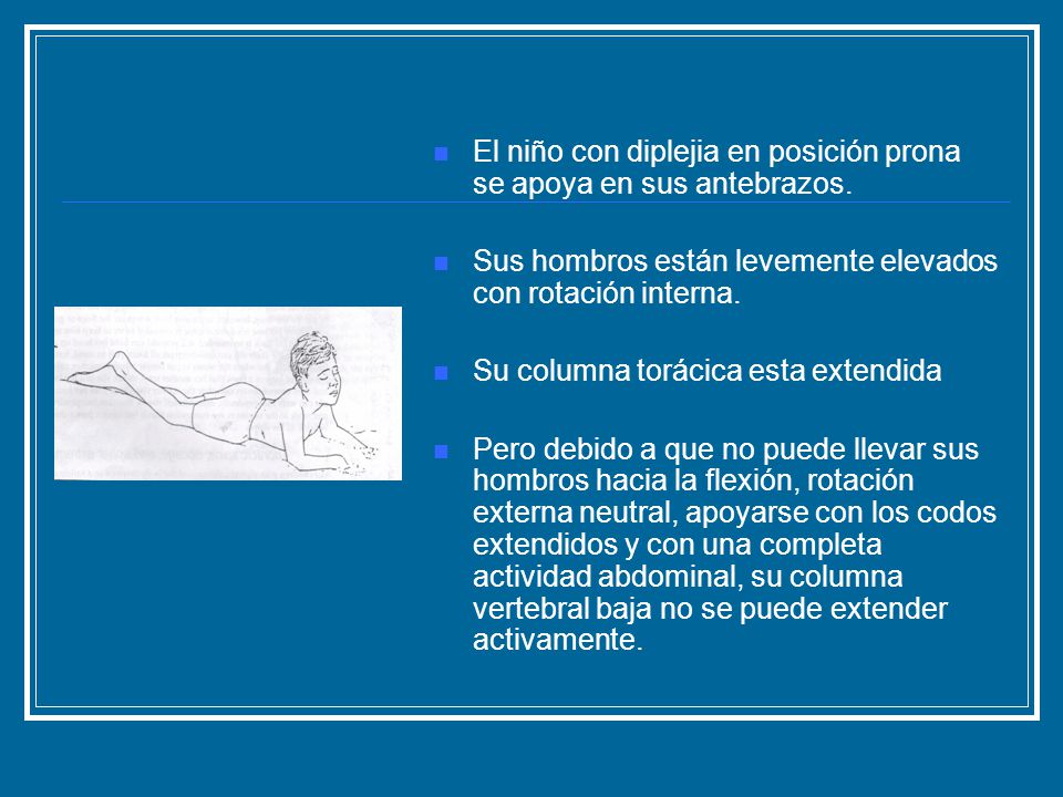 El niño con diplejia en posición prona se apoya en sus antebrazos.