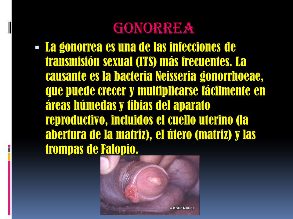 gonorrea