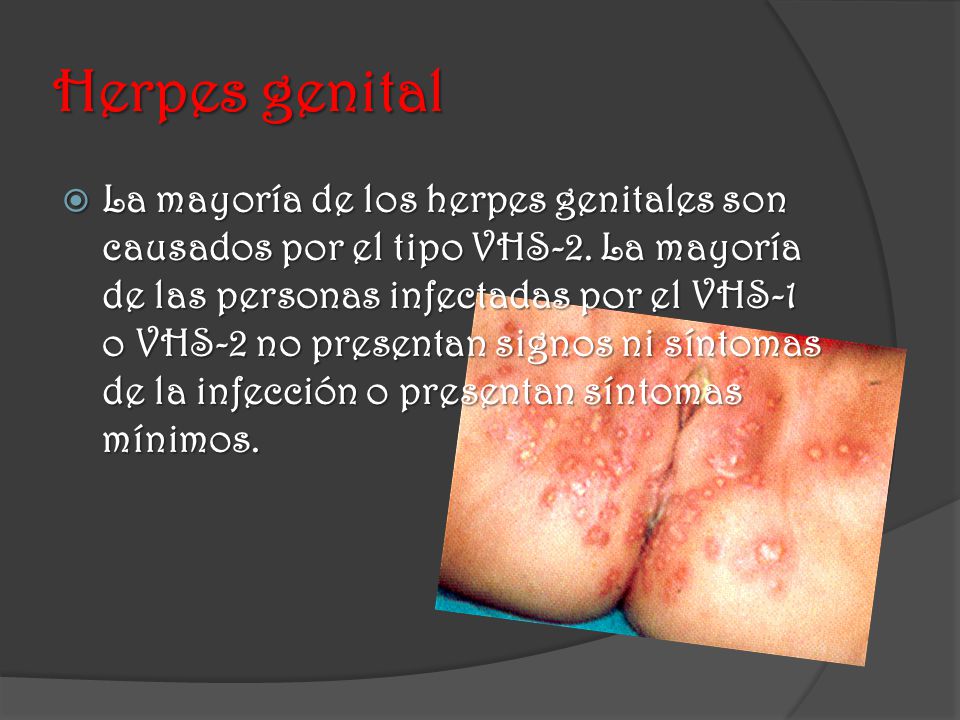 Herpes genital