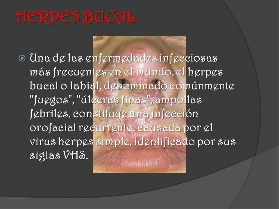 HERPES BUCAL