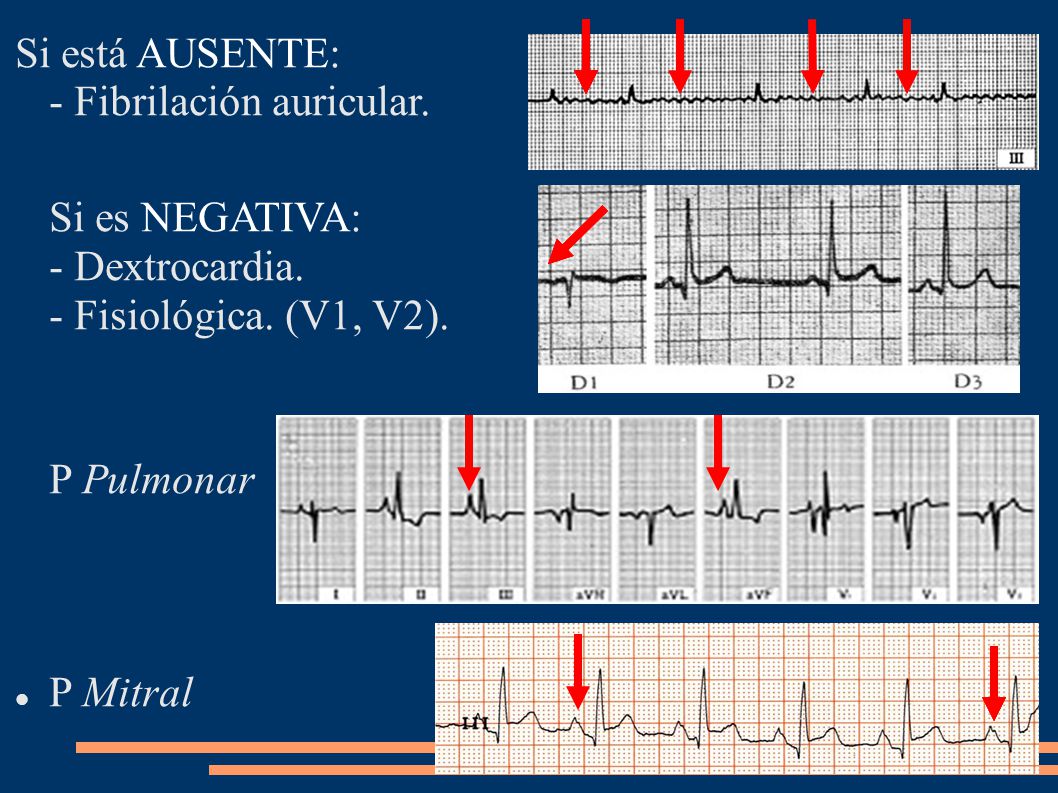 Si está AUSENTE: - Fibrilación auricular.