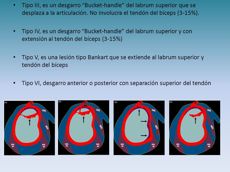 Tipo III, es un desgarro Bucket-handle del labrum superior que se desplaza a la articulación. No involucra el tendón del bíceps (3-15%).
