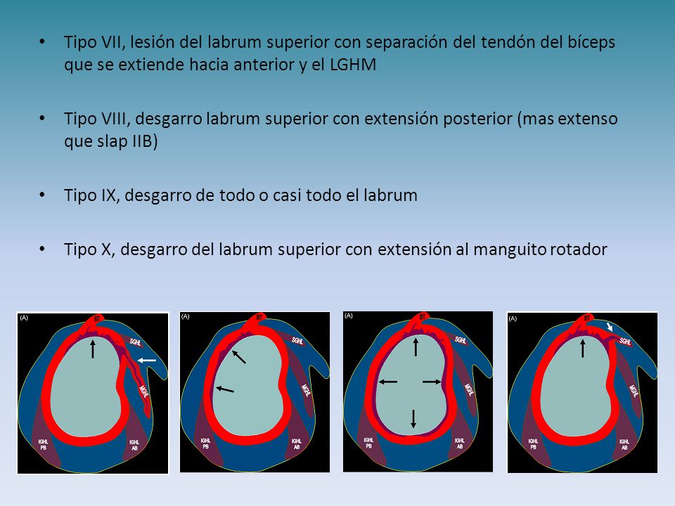 Tipo VII, lesión del labrum superior con separación del tendón del bíceps que se extiende hacia anterior y el LGHM