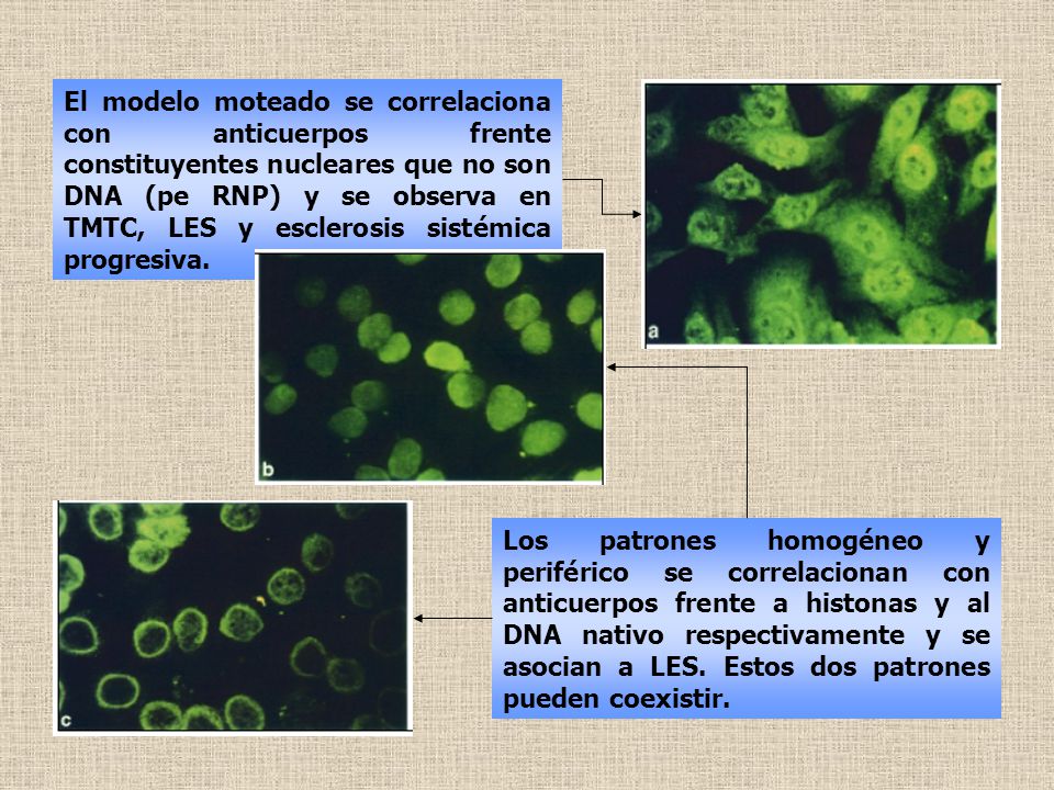 El modelo moteado se correlaciona con anticuerpos frente constituyentes nucleares que no son DNA (pe RNP) y se observa en TMTC, LES y esclerosis sistémica progresiva.