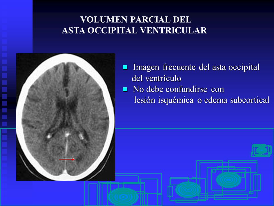 VOLUMEN PARCIAL DEL ASTA OCCIPITAL VENTRICULAR. Imagen frecuente del asta occipital. del ventrículo.