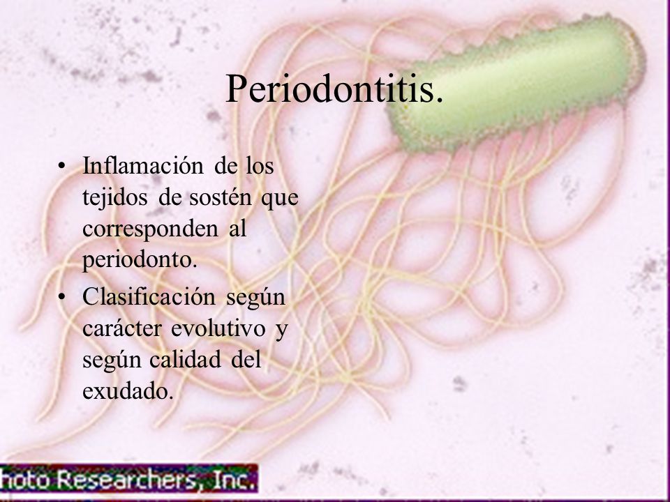 Periodontitis. Inflamación de los tejidos de sostén que corresponden al periodonto.