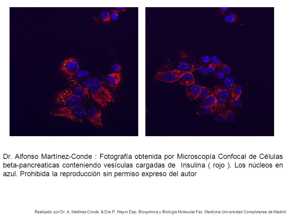 Dr. Alfonso Martínez-Conde : Fotografía obtenida por Microscopía Confocal de Células beta-pancreaticas conteniendo vesículas cargadas de Insulina ( rojo ). Los núcleos en azul. Prohibida la reproducción sin permiso expreso del autor