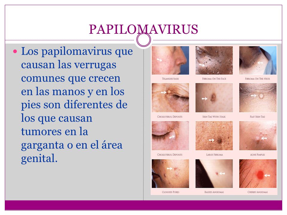 acnee papiloma)