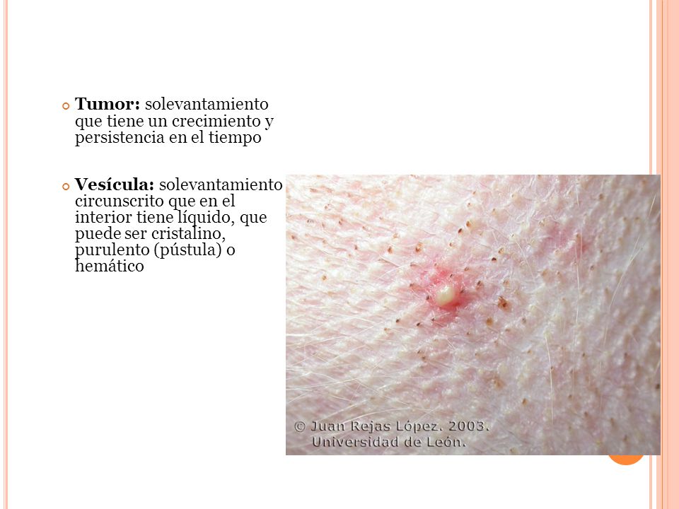 Tumor: solevantamiento que tiene un crecimiento y persistencia en el tiempo