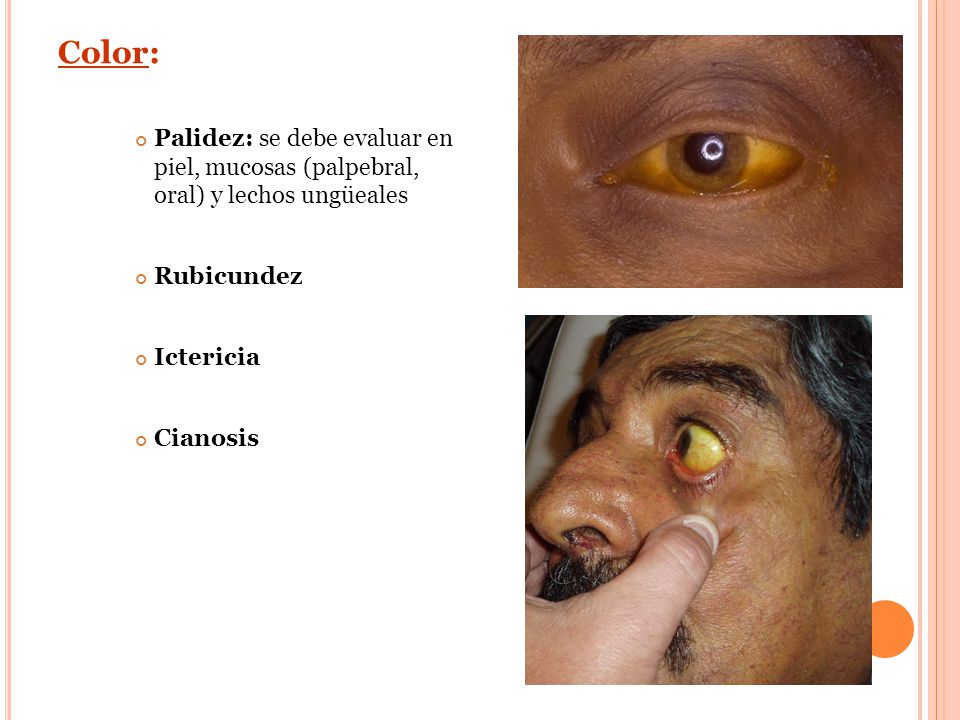 Color: Palidez: se debe evaluar en piel, mucosas (palpebral, oral) y lechos ungüeales. Rubicundez.