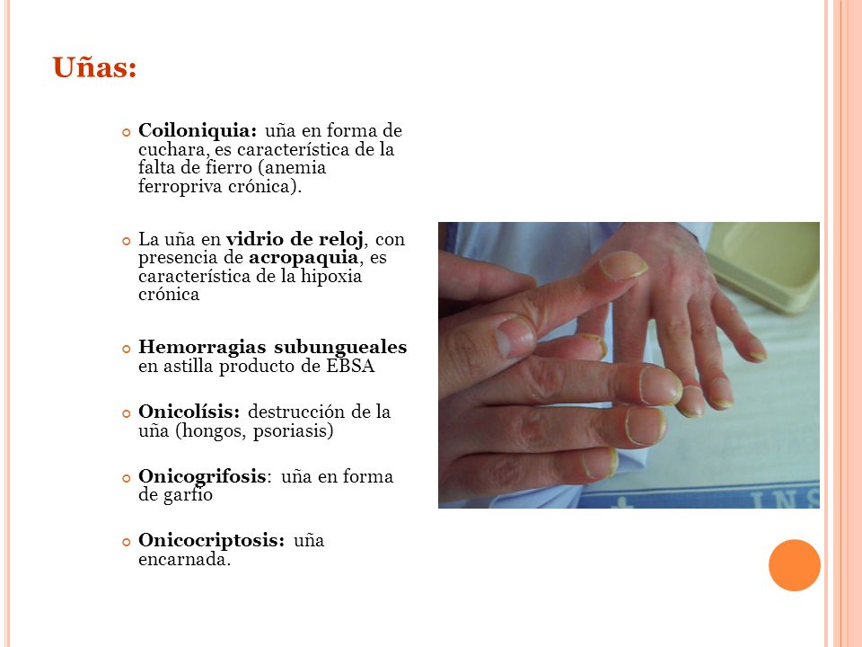 Uñas: Coiloniquia: uña en forma de cuchara, es característica de la falta de fierro (anemia ferropriva crónica).