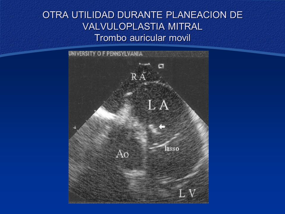 OTRA UTILIDAD DURANTE PLANEACION DE VALVULOPLASTIA MITRAL Trombo auricular movil