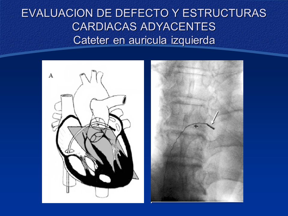 EVALUACION DE DEFECTO Y ESTRUCTURAS CARDIACAS ADYACENTES Cateter en auricula izquierda