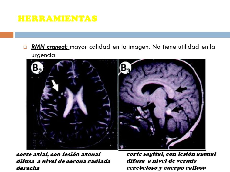 HERRAMIENTAS RMN craneal: mayor calidad en la imagen. No tiene utilidad en la urgencia.