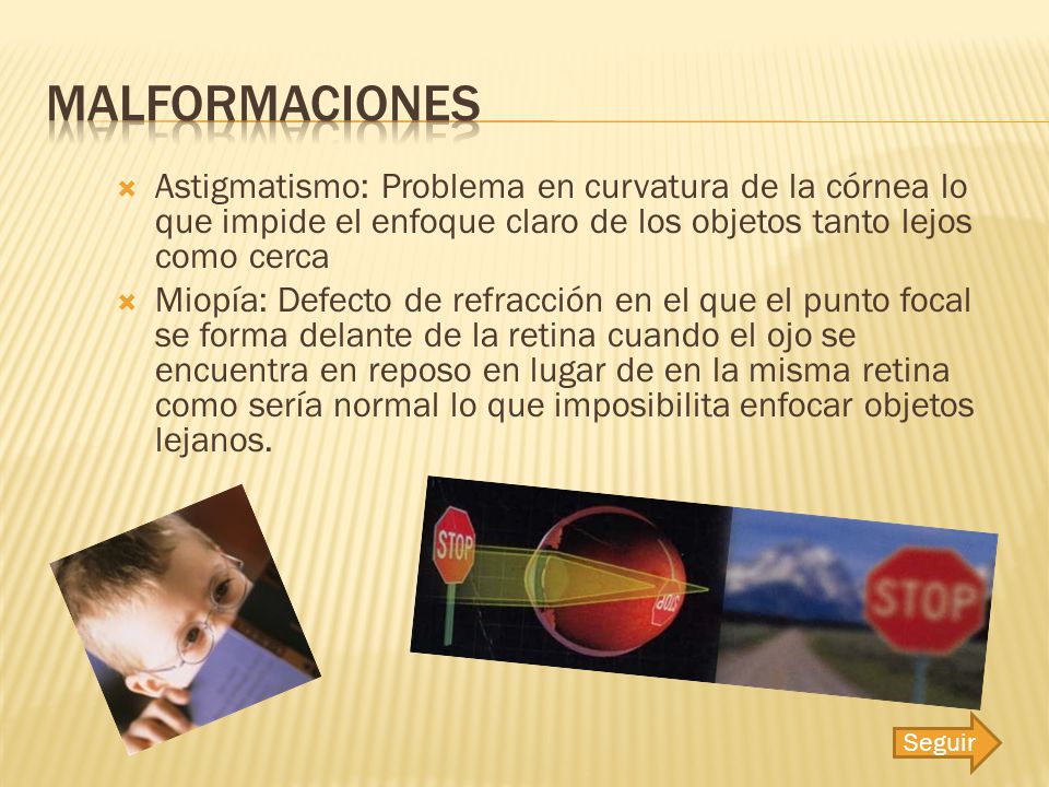 Malformaciones Astigmatismo: Problema en curvatura de la córnea lo que impide el enfoque claro de los objetos tanto lejos como cerca.