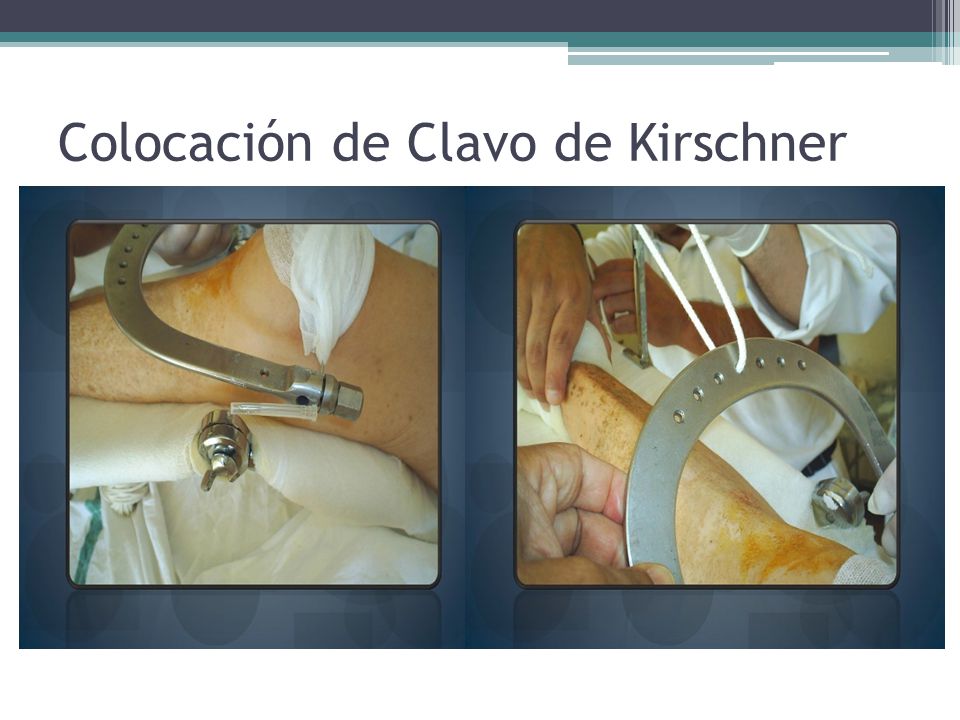 Colocación de Clavo de Kirschner