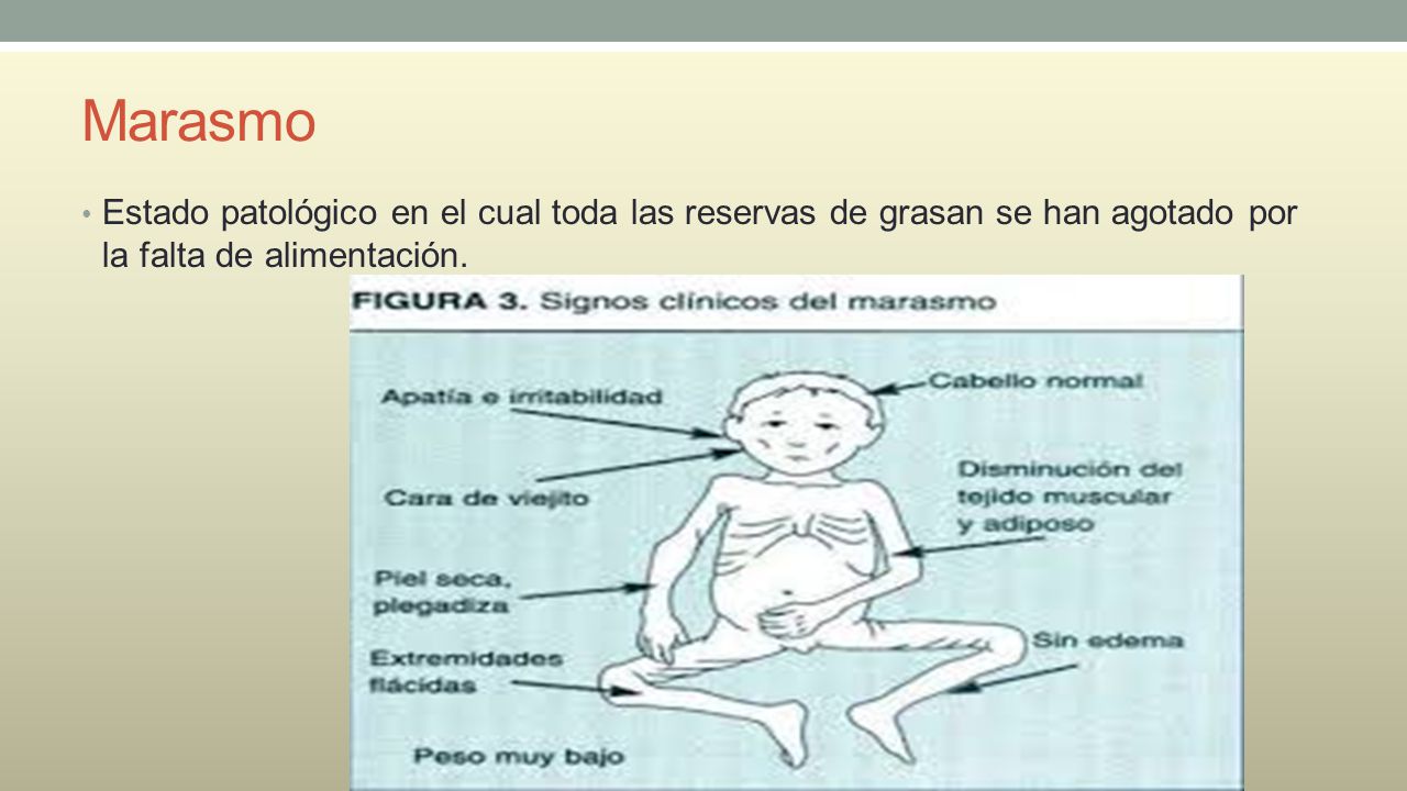 Marasmo Estado patológico en el cual toda las reservas de grasan se han agotado por la falta de alimentación.