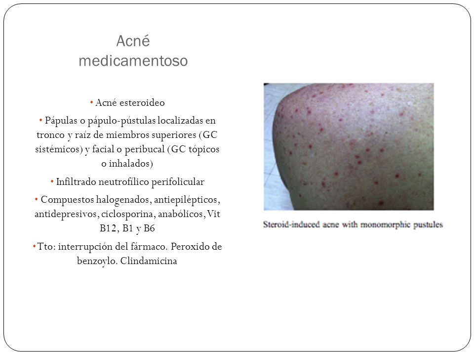 Acné medicamentoso Acné esteroideo