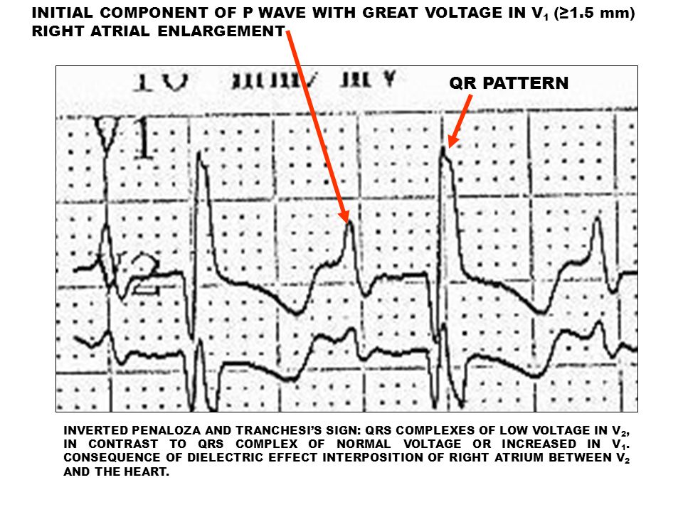 INITIAL COMPONENT OF P WAVE WITH GREAT VOLTAGE IN V1 (≥1.5 mm)